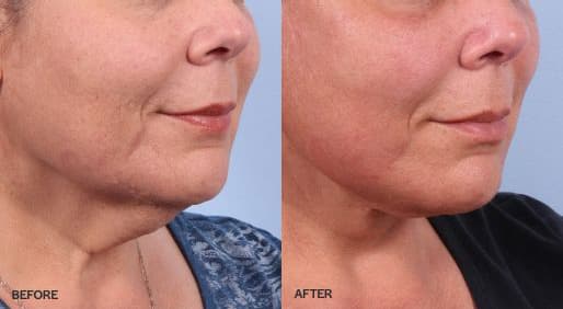 Facelift before and after photo of a woman