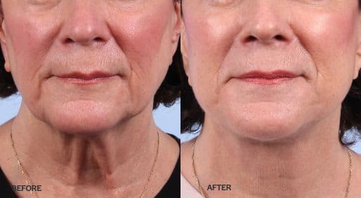 Facelift before and after photo of a woman