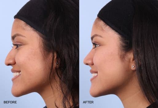 Rhinoplasty before and after photo of a woman