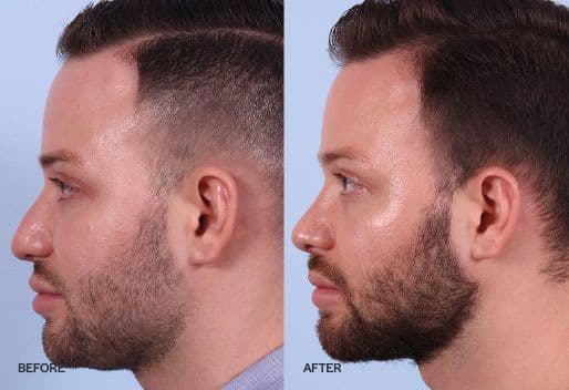 Rhinoplasty before and after photo of a man