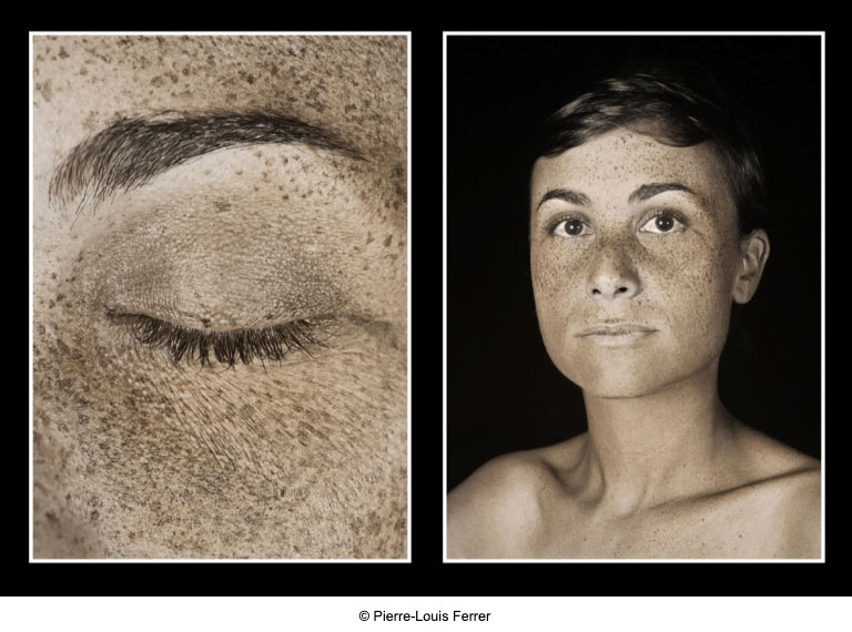 Sun Damage: UV Photos | RefinedMD, Los Gatos + San Jose