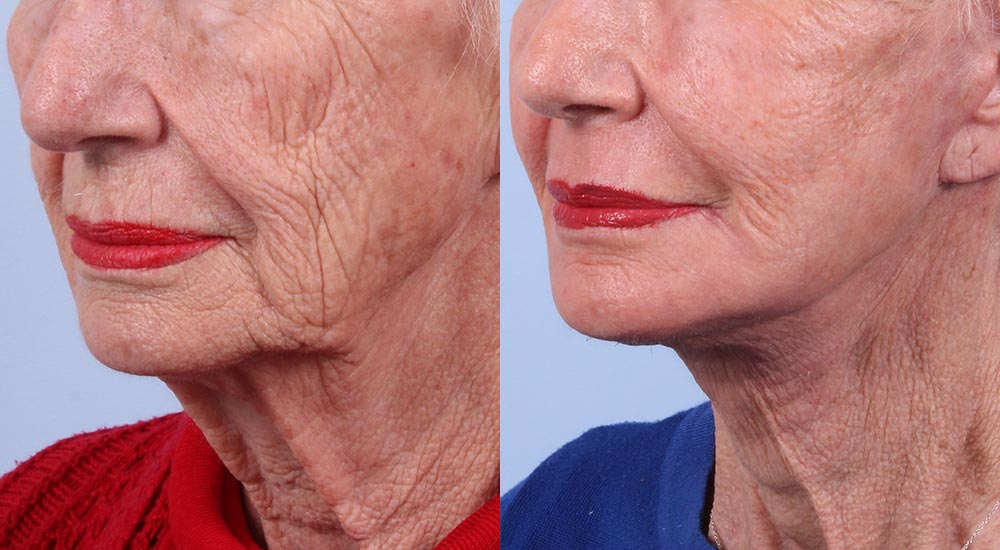 Facelift Patient 1 | Dr. Sudeep Roy | RefinedMD, Los Gatos, CA
