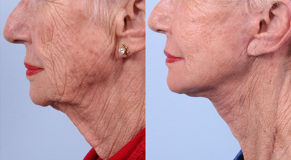 Facelift Patient 1 | Dr. Sudeep Roy | RefinedMD, Los Gatos, CA
