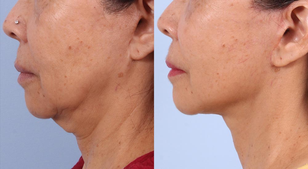 Facelift Patient 11 Photos | Dr. Sudeep Roy, RefinedMD