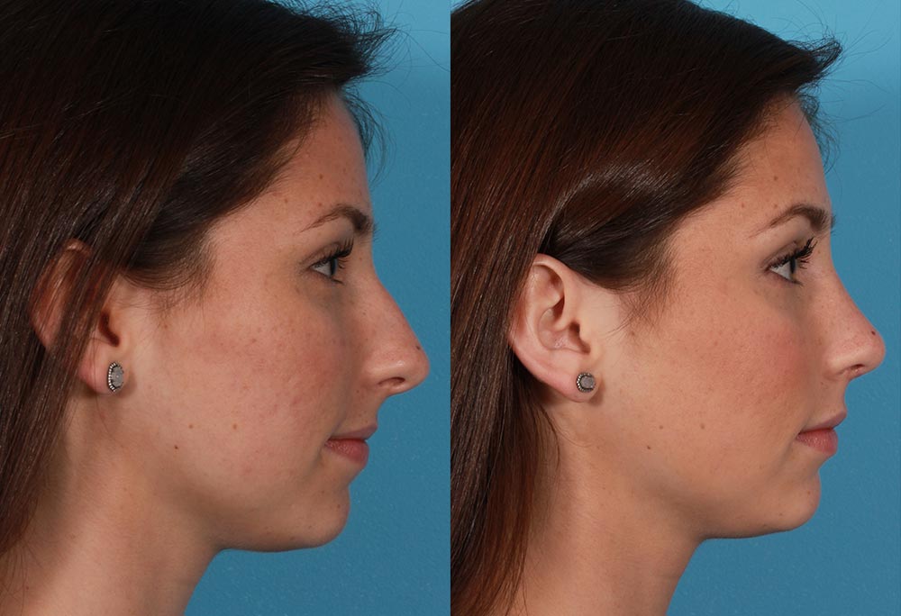 Rhinoplasty Patient 1 Photos | Dr. Sudeep Roy, RefinedMD