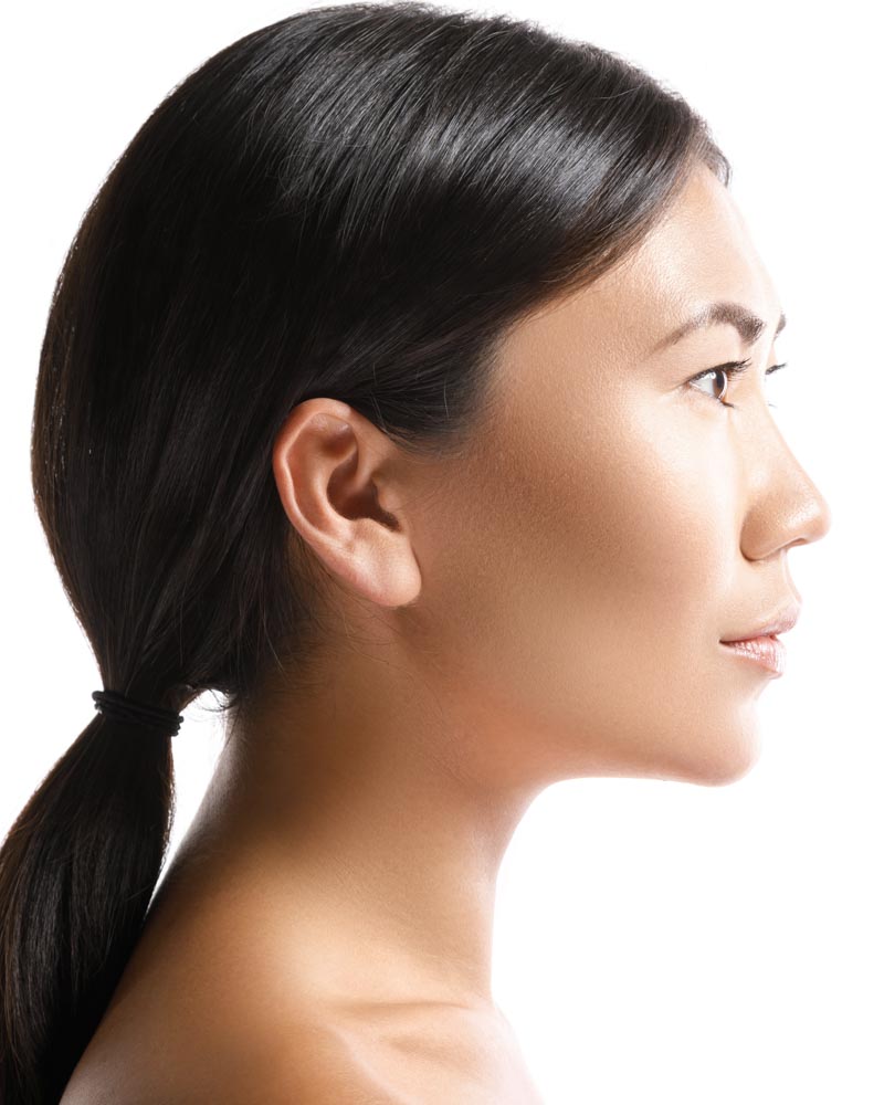 Kybella For Double Chin, RefinedMD, Los Gatos