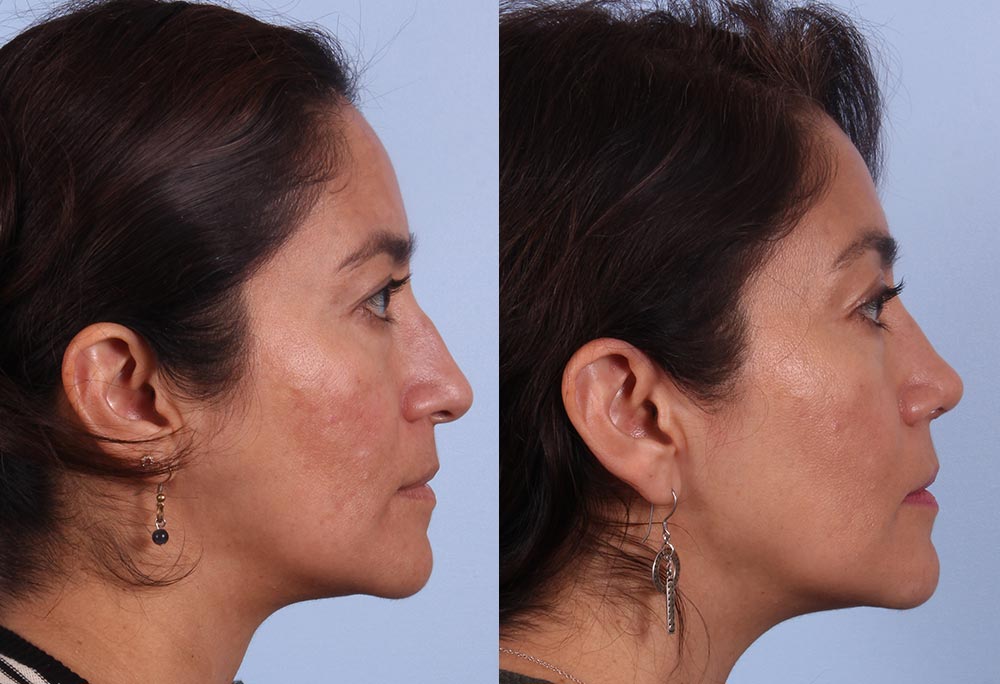 Why Right Now is the BEST Time for Rhinoplasty | RefinedMD, Los Gatos