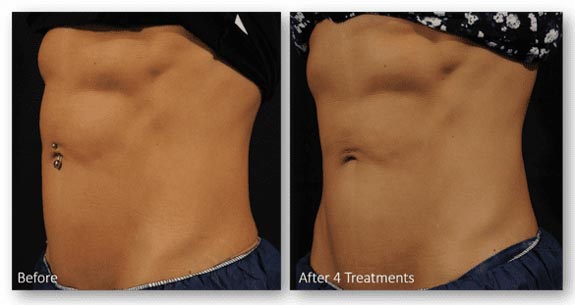 Accufit Body Toning | RefinedMD, Los Gatos