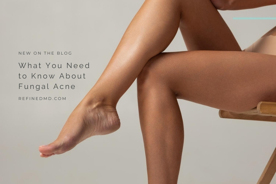 What You Need to Know About Fungal Acne