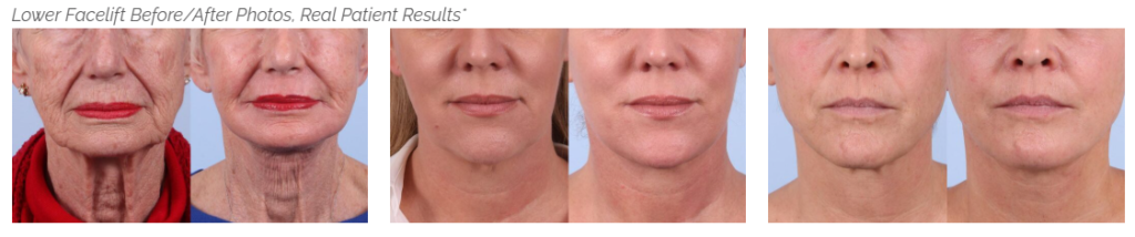 Lower facelift before and after photos