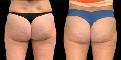 Emtone Before/After*