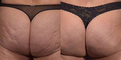 Cellfina Before/After*