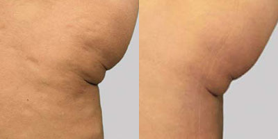 Exilis Before/After*