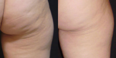 Z-Wave Before/After*
