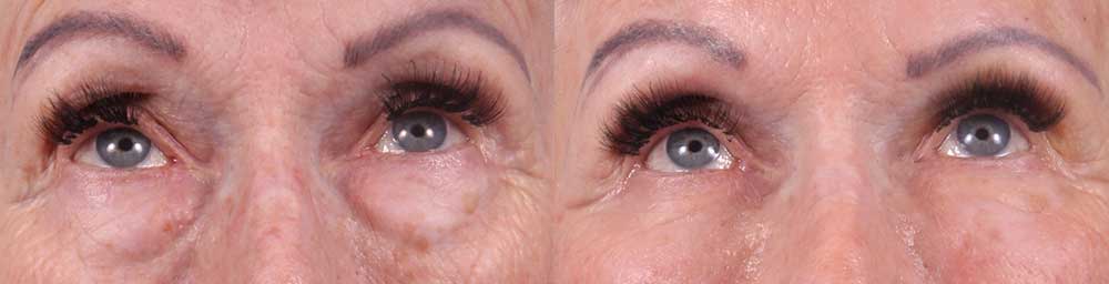 Lower Eyelids Patient 3 Photos | Dr. Sudeep Roy, RefinedMD