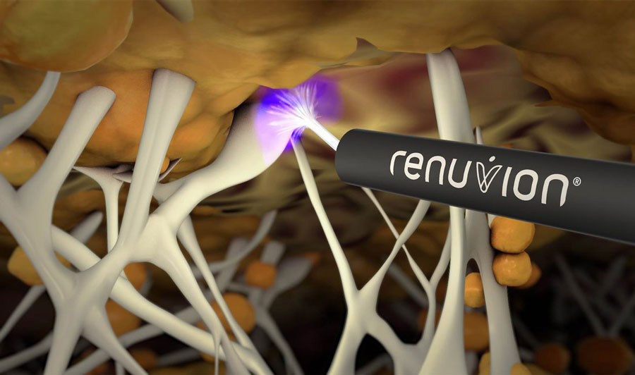 Renuvion J-Plasma Skin Tightening | Dr. Sudeep Roy, RefinedMD