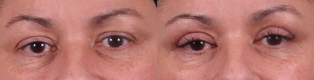 Upper Eyelids Patient 5 Photos | Dr. Sudeep Roy, RefinedMD