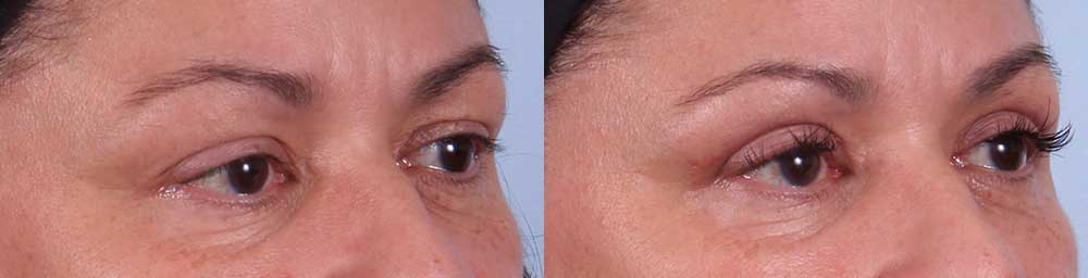 Upper Eyelids Patient 5 Photos | Dr. Sudeep Roy, RefinedMD