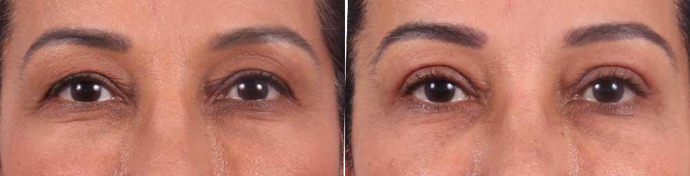 Upper Eyelids Patient 7 | Dr. Sudeep Roy | RefinedMD, Los Gatos, CA