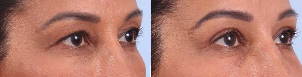 Upper Eyelids Patient 7 | Dr. Sudeep Roy | RefinedMD, Los Gatos, CA