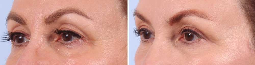 Upper and Lower Eyelids Patient 8 Photos | Dr. Sudeep Roy, RefinedMD