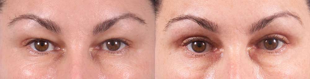 Upper Eyelids Patient 15 Photos | Dr. Sudeep Roy, RefinedMD