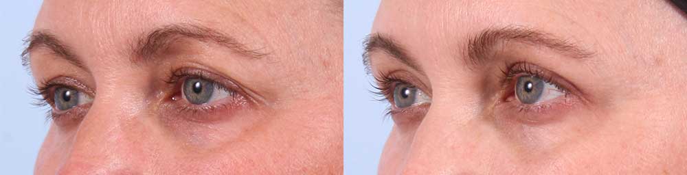 Upper Eyelids Patient 16 Photos | Dr. Sudeep Roy, RefinedMD