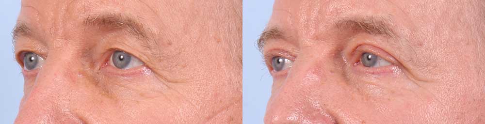 Upper Eyelids Patient 17 Photos | Dr. Sudeep Roy, RefinedMD