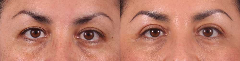Upper Eyelids Patient 19 Photos | Dr. Sudeep Roy, RefinedMD