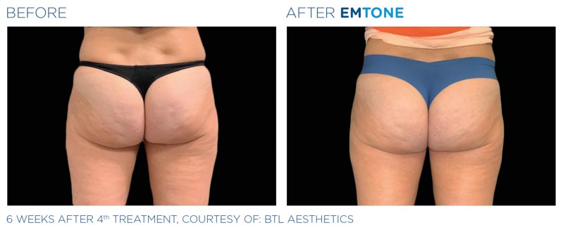 Emtone Skin Tightening and Cellulite | RefinedMD | Los Gatos