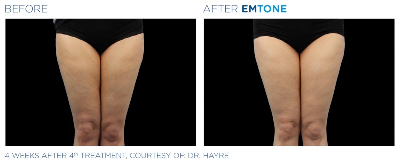 Emtone Skin Tightening and Cellulite | RefinedMD | Los Gatos