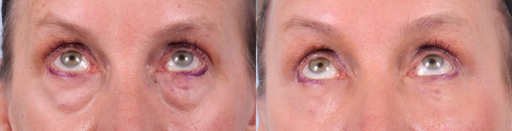 Lower Eyelids Patient 4 Photos | Dr. Sudeep Roy, RefinedMD