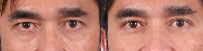 Lower Eyelids Patient 5 Photos | Dr. Sudeep Roy, RefinedMD