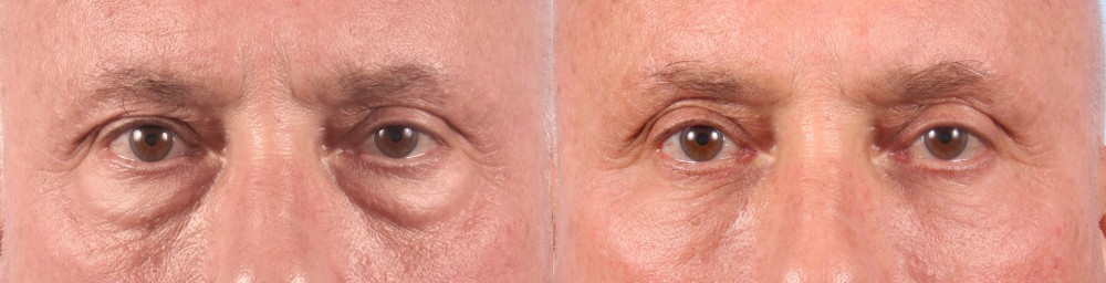 Lower Eyelids Patient 6 Photos | Dr. Sudeep Roy, RefinedMD