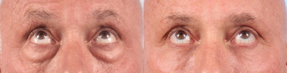 Lower Eyelids Patient 6 Photos | Dr. Sudeep Roy, RefinedMD