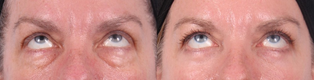 Lower Eyelids Patient 7 Photos | Dr. Sudeep Roy, RefinedMD