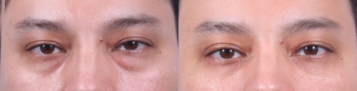 Lower Eyelids Patient 8 Photos | Dr. Sudeep Roy, RefinedMD