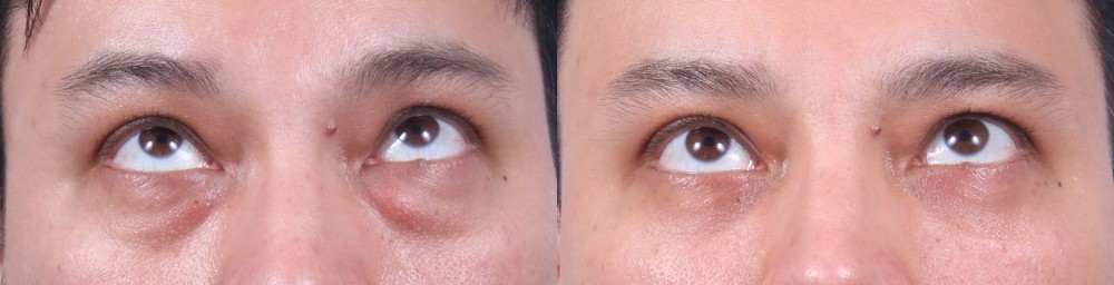 Lower Eyelids Patient 8 Photos | Dr. Sudeep Roy, RefinedMD