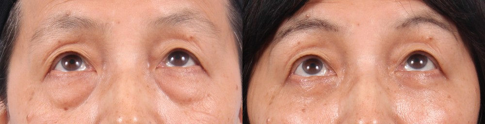 Lower Eyelids Patient 9 Photos | Dr. Sudeep Roy, RefinedMD