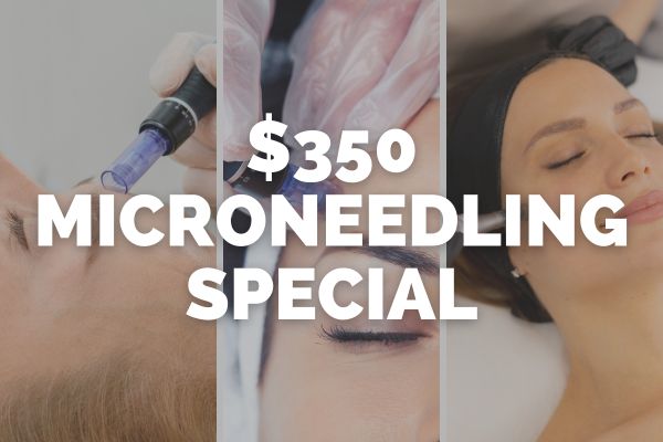 microneedling